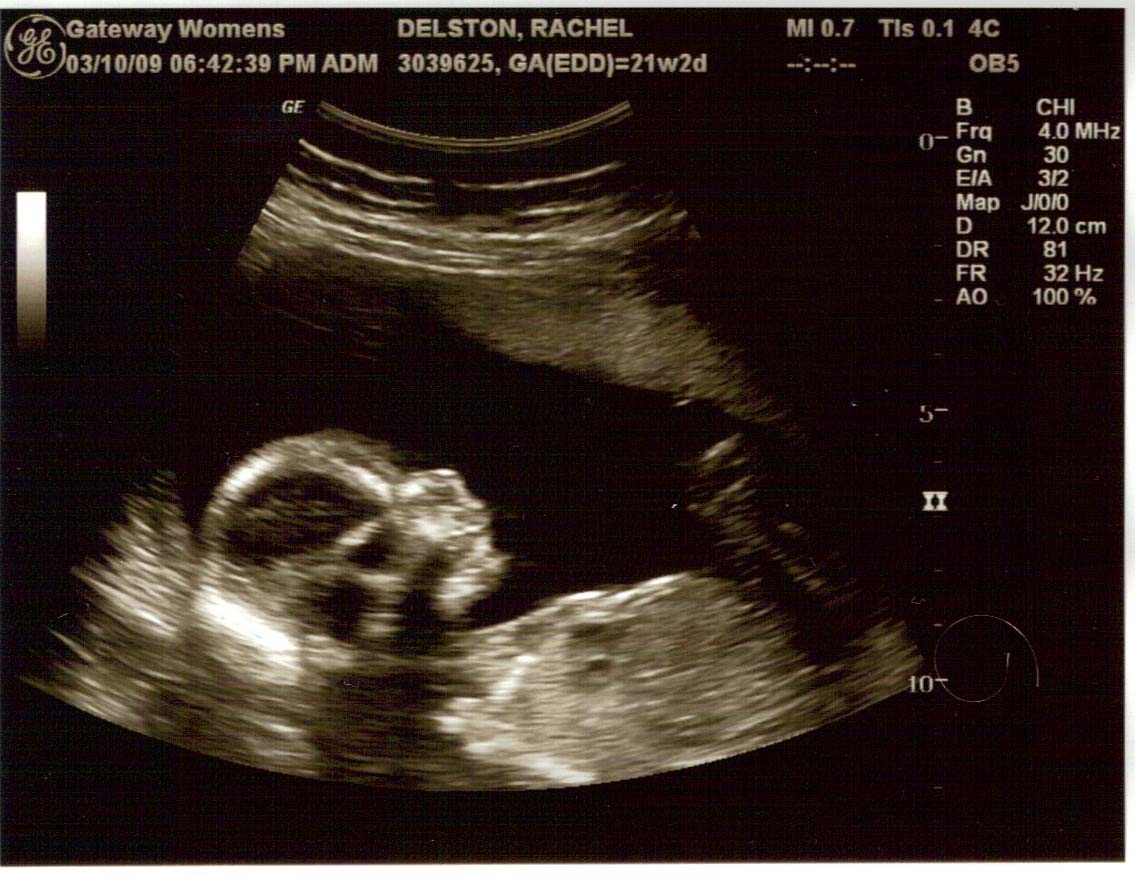 Ultrasound pic from 18 weeks