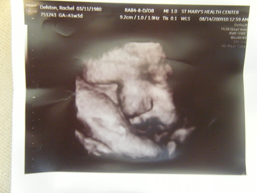 3D Ultrasound