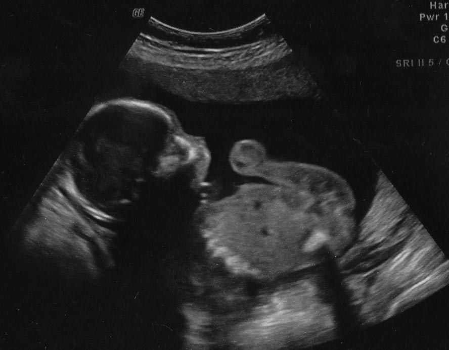 Baby Byron 18 weeks, 10 ounces